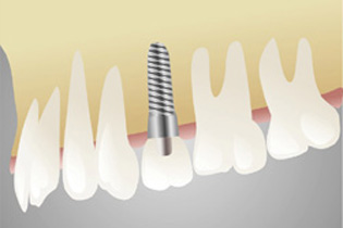 Implantologie - Dr. Dürr Zahnmedizin